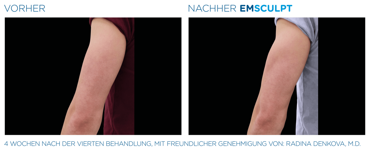 Oberarm Vorher-Nachher Vergleich