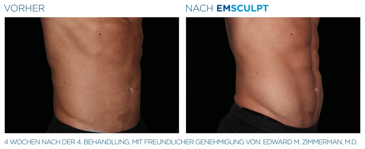 Bauchmuskulatur Vorher-Nachher Vergleich