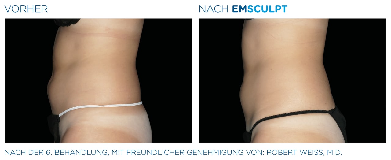 Bauch (Seitenansicht) Vorher-Nachher Vergleich
