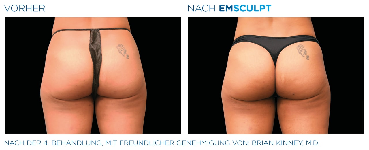 Gesässmuskulatur Vorher-Nachher Vergleich