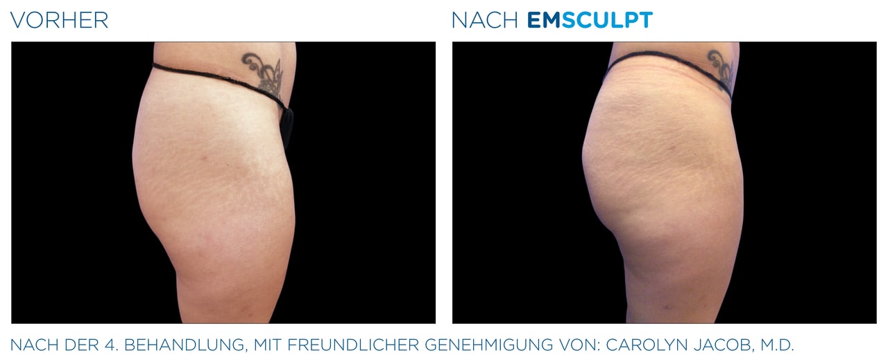 Oberschenkel Vorher-Nachher Vergleich